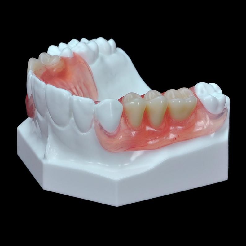 Phục Hình Tháo Lắp – Giải Pháp Phục Hồi Răng Mất An Toàn