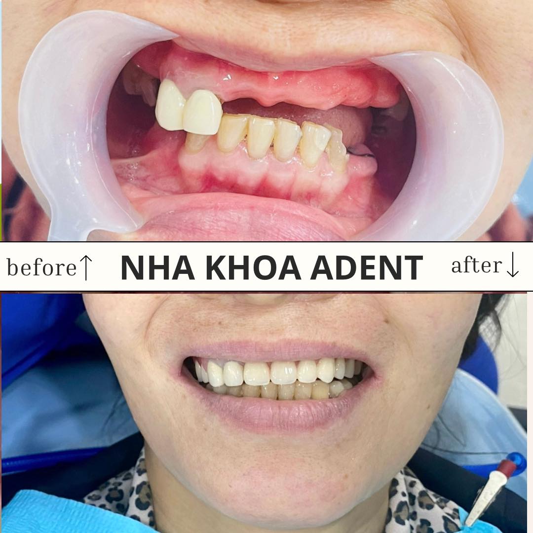 Phục Hình Tháo Lắp – Giải Pháp Phục Hồi Răng Mất An Toàn
