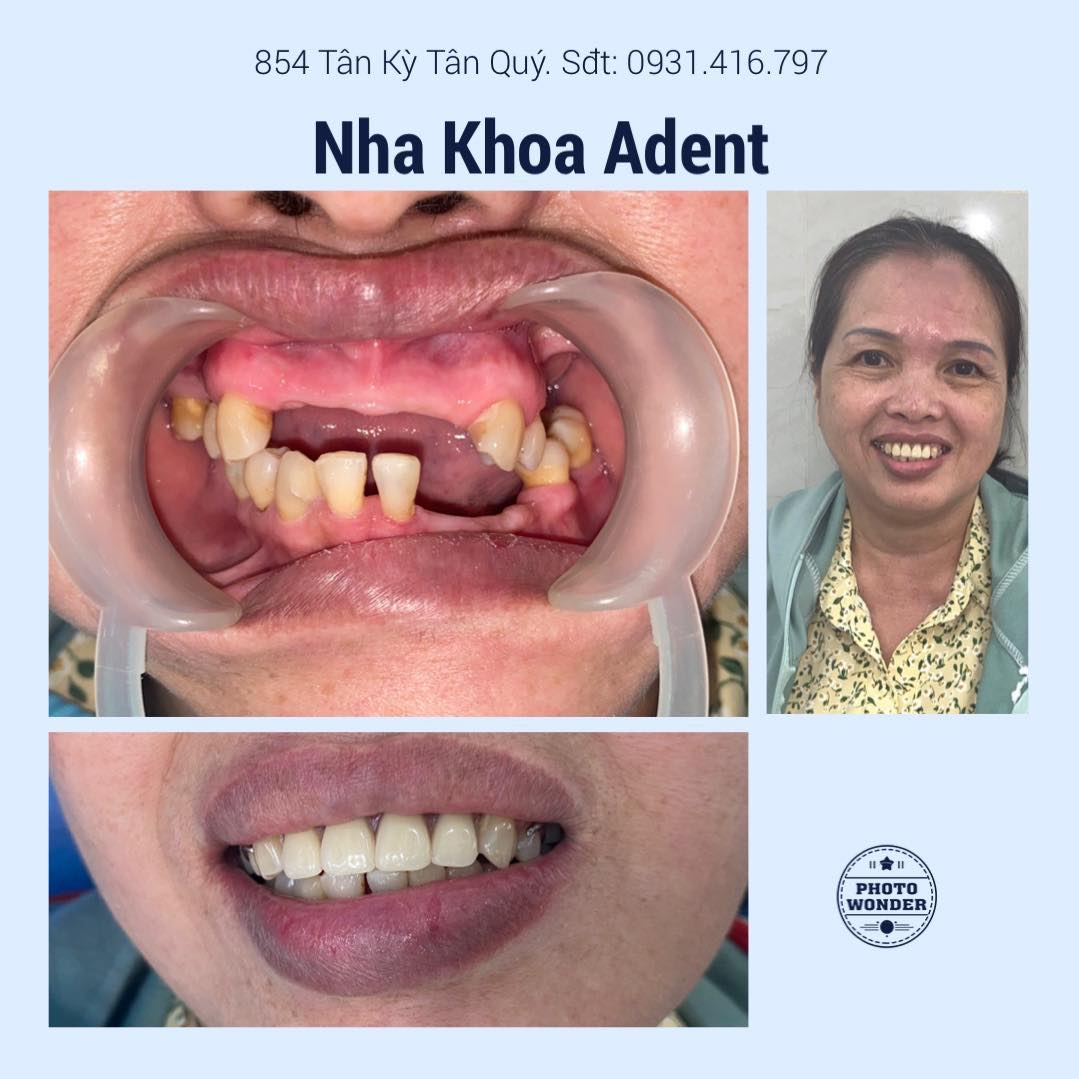 Phục Hình Tháo Lắp – Giải Pháp Phục Hồi Răng Mất An Toàn