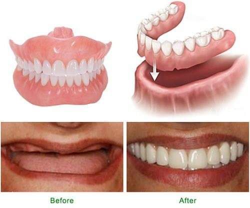 Phục Hình Tháo Lắp – Giải Pháp Phục Hồi Răng Mất An Toàn