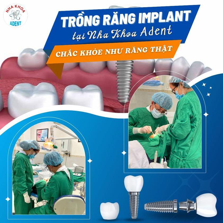 Trồng Răng Implant