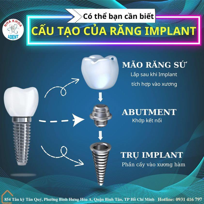 Trồng Răng Implant