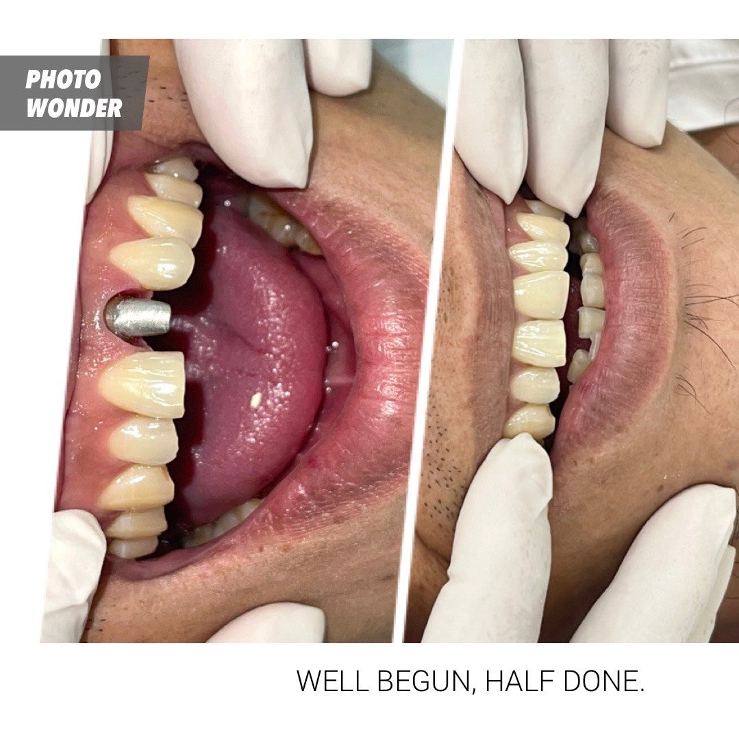 Trồng Răng Implant