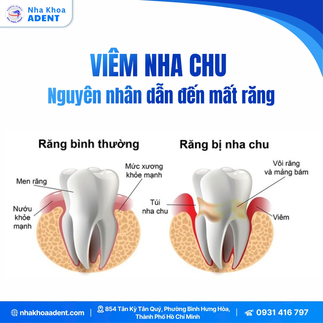 5 Dấu Hiệu Viêm Nha Chu (15)