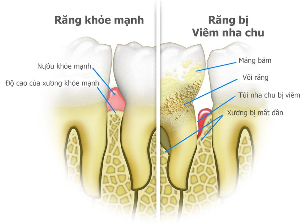 5 Dấu Hiệu Viêm Nha Chu (4)