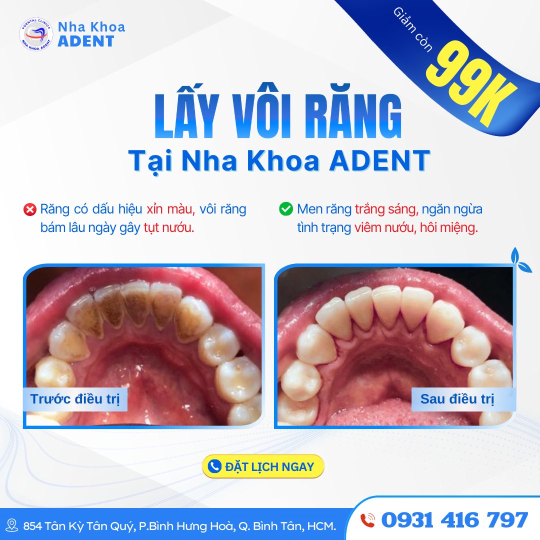 Cạo Vôi Răng Giá Bao Nhiêu