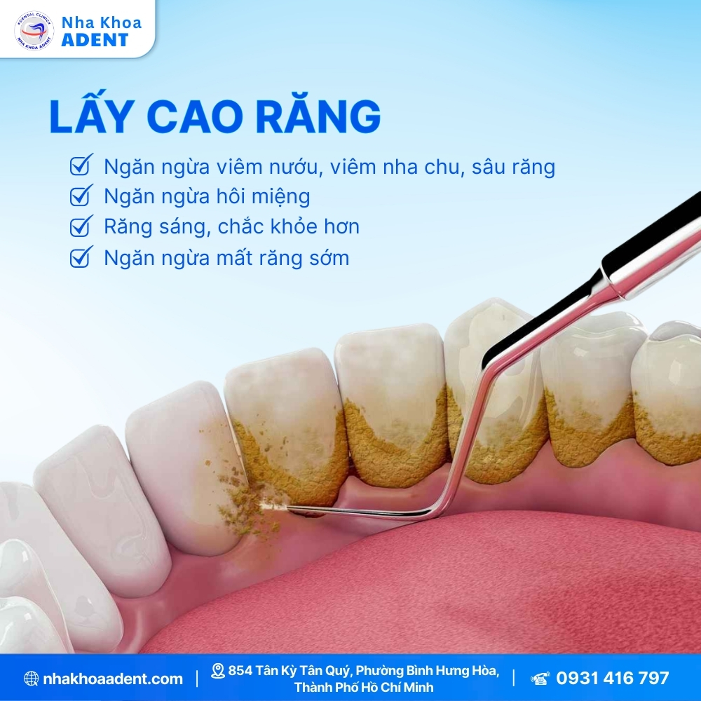 Cạo Vôi Răng Giá Bao Nhiêu