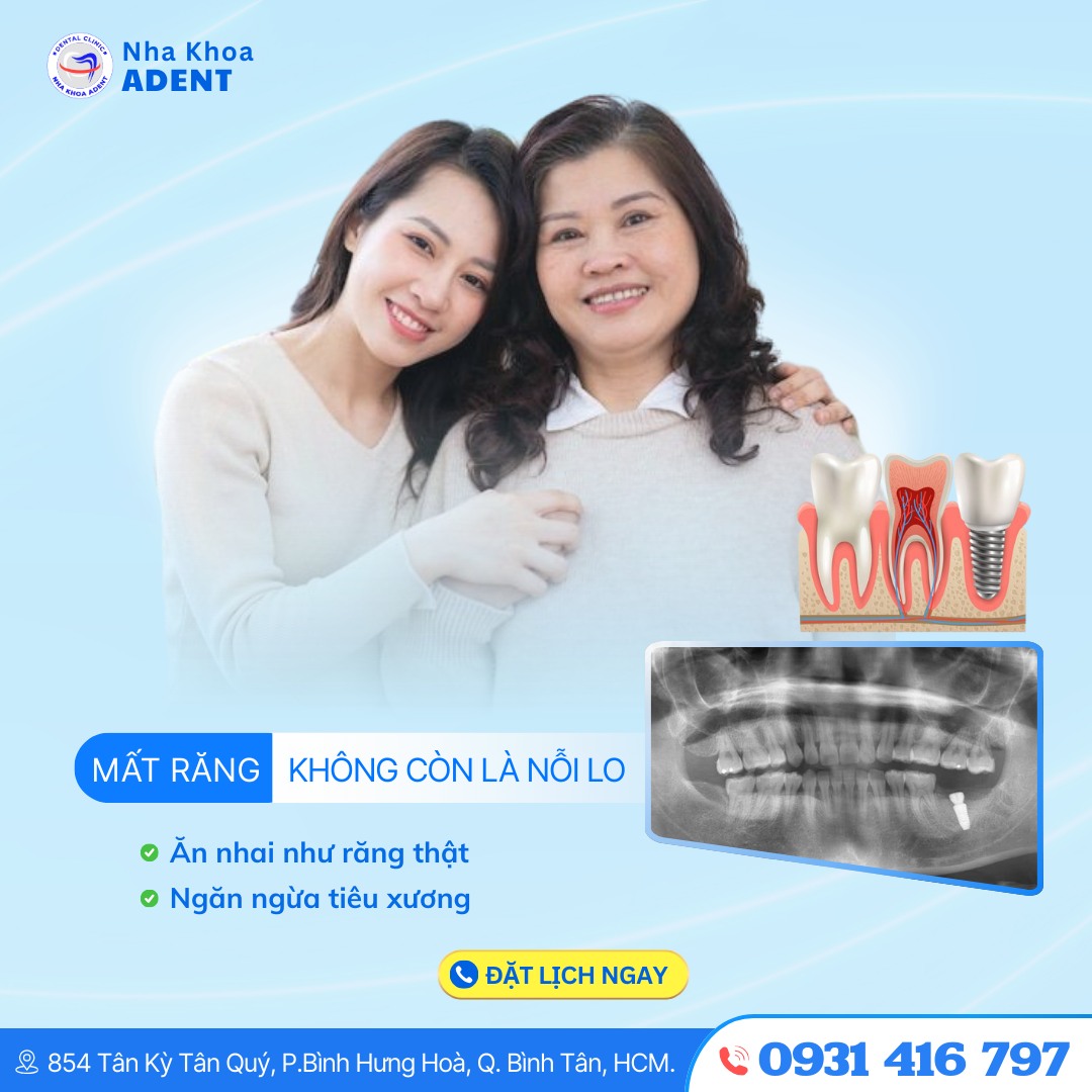 Lợi Ích Khi Trồng Răng Implant