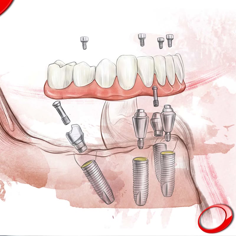 Lợi Ích Khi Trồng Răng Implant