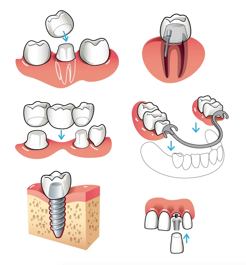 Lợi Ích Khi Trồng Răng Implant