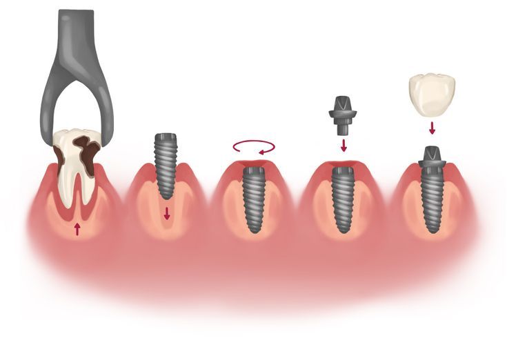 Lợi Ích Khi Trồng Răng Implant