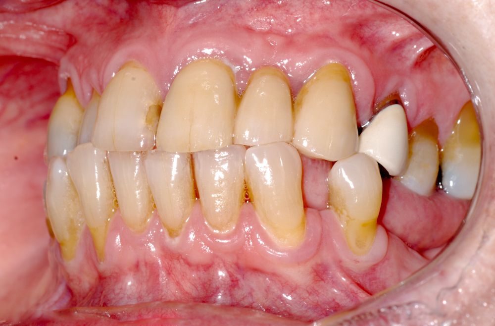 Mất Răng Có Nguy Hiểm Không Hậu Quả Và Giải Pháp Điều Trị