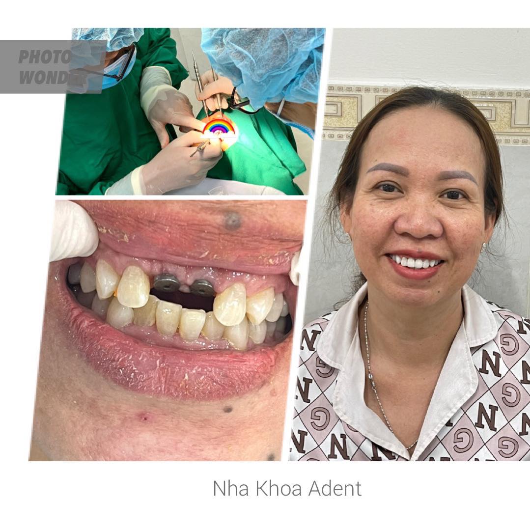 Mất Răng Có Nguy Hiểm Không Hậu Quả Và Giải Pháp Điều Trị