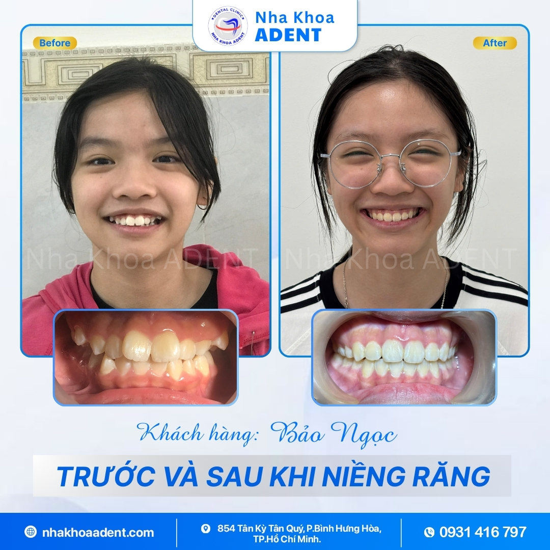 Nha Khoa Bình Tân Uy Tín Adent