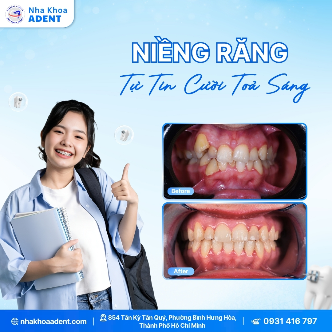 Niềng Răng Bao Nhiêu Tiền Bảng Giá Niềng Răng Chi Tiết 2025