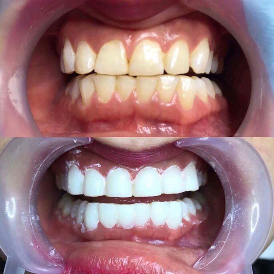 Phủ Răng Sứ Nano Là Gì Có Nên Lựa Chọn Không