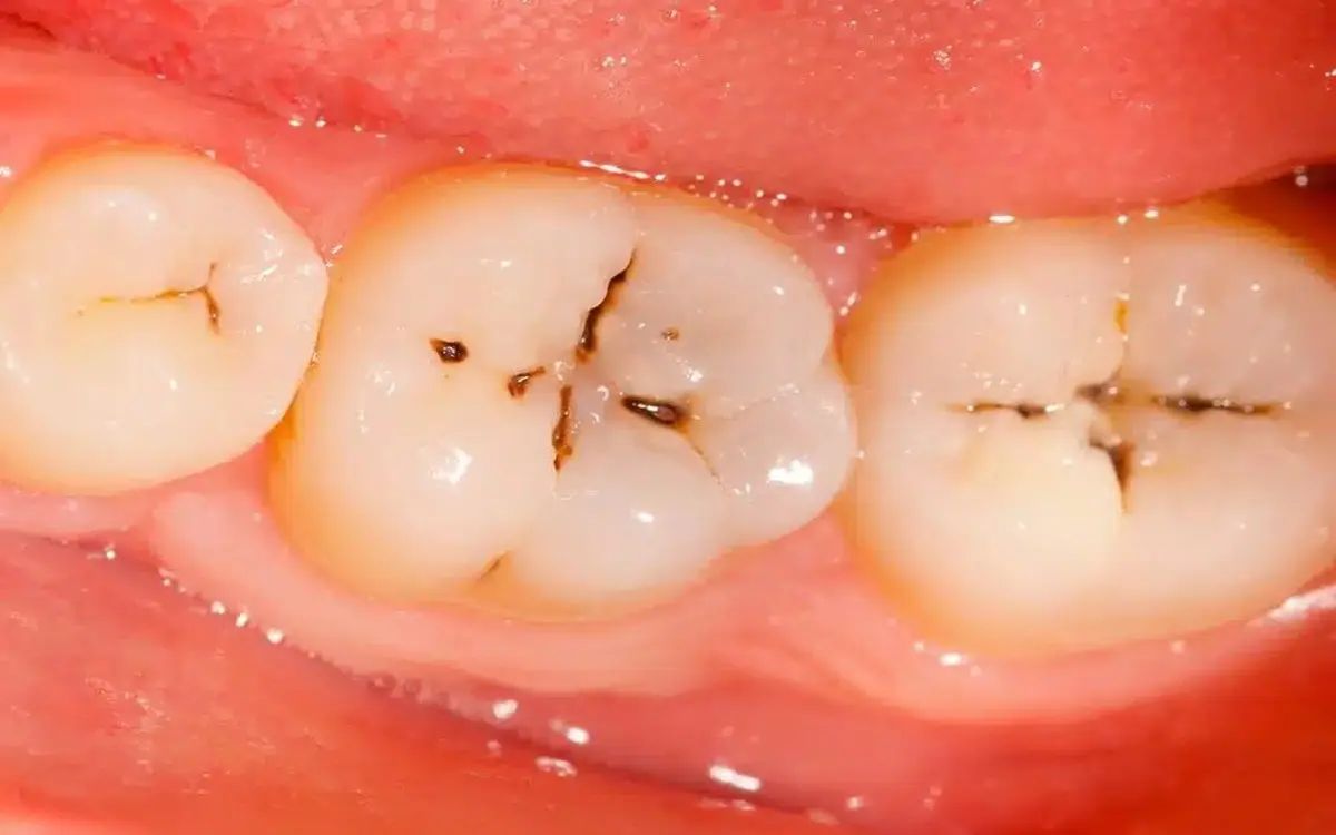 Sâu Răng Là Gì