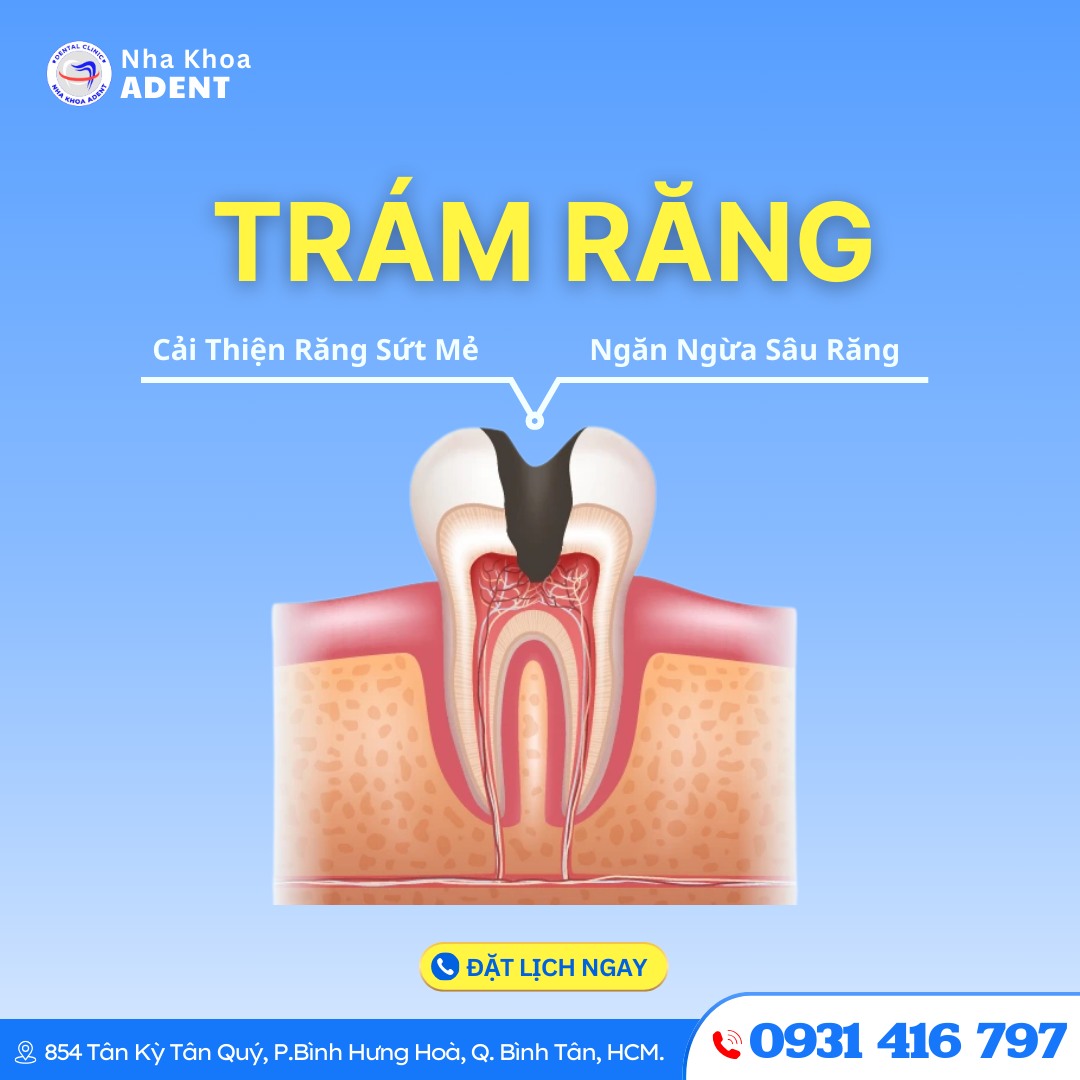 Trám Răng Bao Nhiêu Tiền (1)