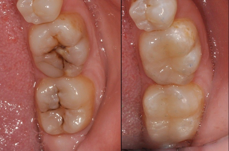 Trám Răng Bao Nhiêu Tiền (2)