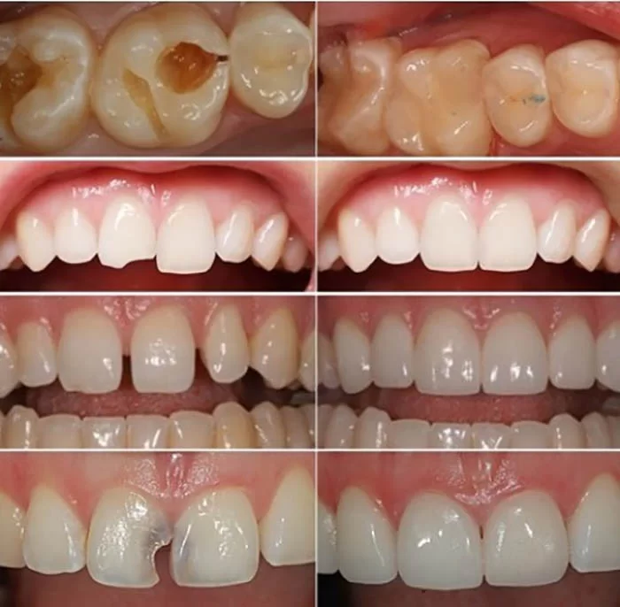 Trám Răng Bao Nhiêu Tiền (2)