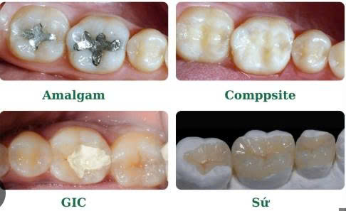 Trám Răng Là Gì Quy Trình Thực Hiện Như Thế Nào