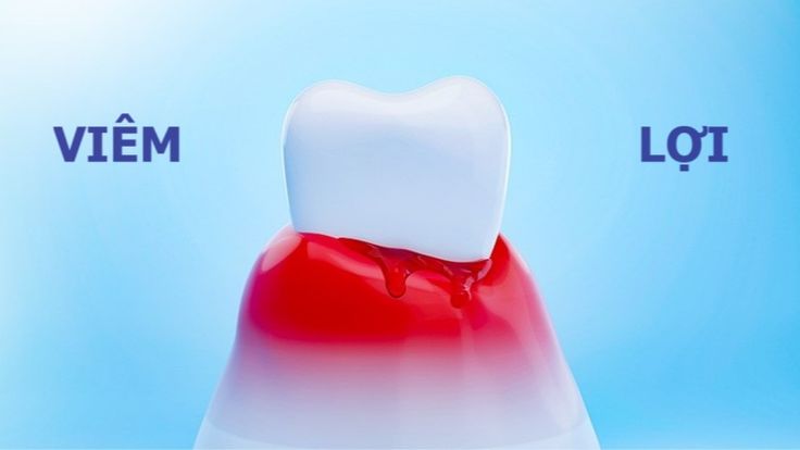 Viêm Lợi Là Gì Dấu Hiệu Nhận Biết Và Cách Điều Trị