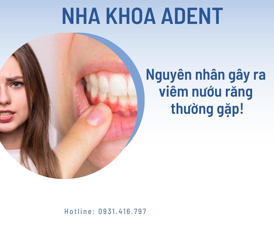 Viêm Lợi Là Gì Dấu Hiệu Nhận Biết Và Cách Điều Trị