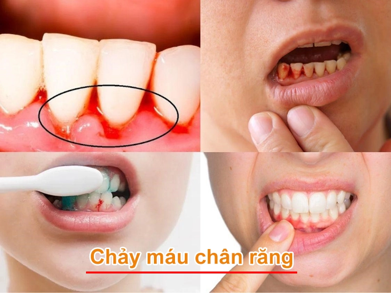 Chảy Máu Chân Răng Nguyên Nhân, Cách Điều Trị Và Phòng Ngừa (1)