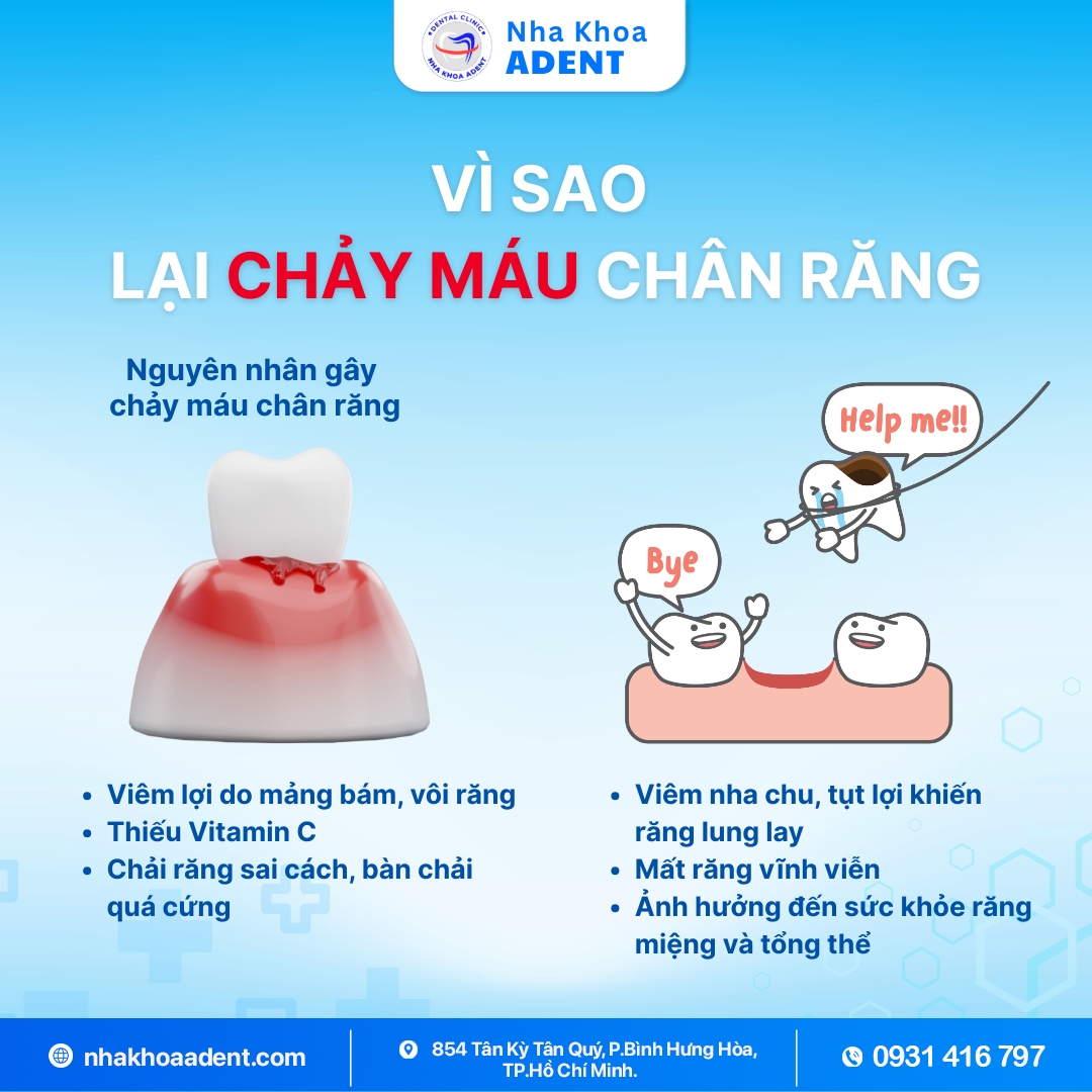 Chảy Máu Chân Răng Nguyên Nhân, Cách Điều Trị Và Phòng Ngừa