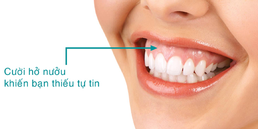 Cười Hở Lợi Nguyên Nhân Và Phương Pháp Điều Trị