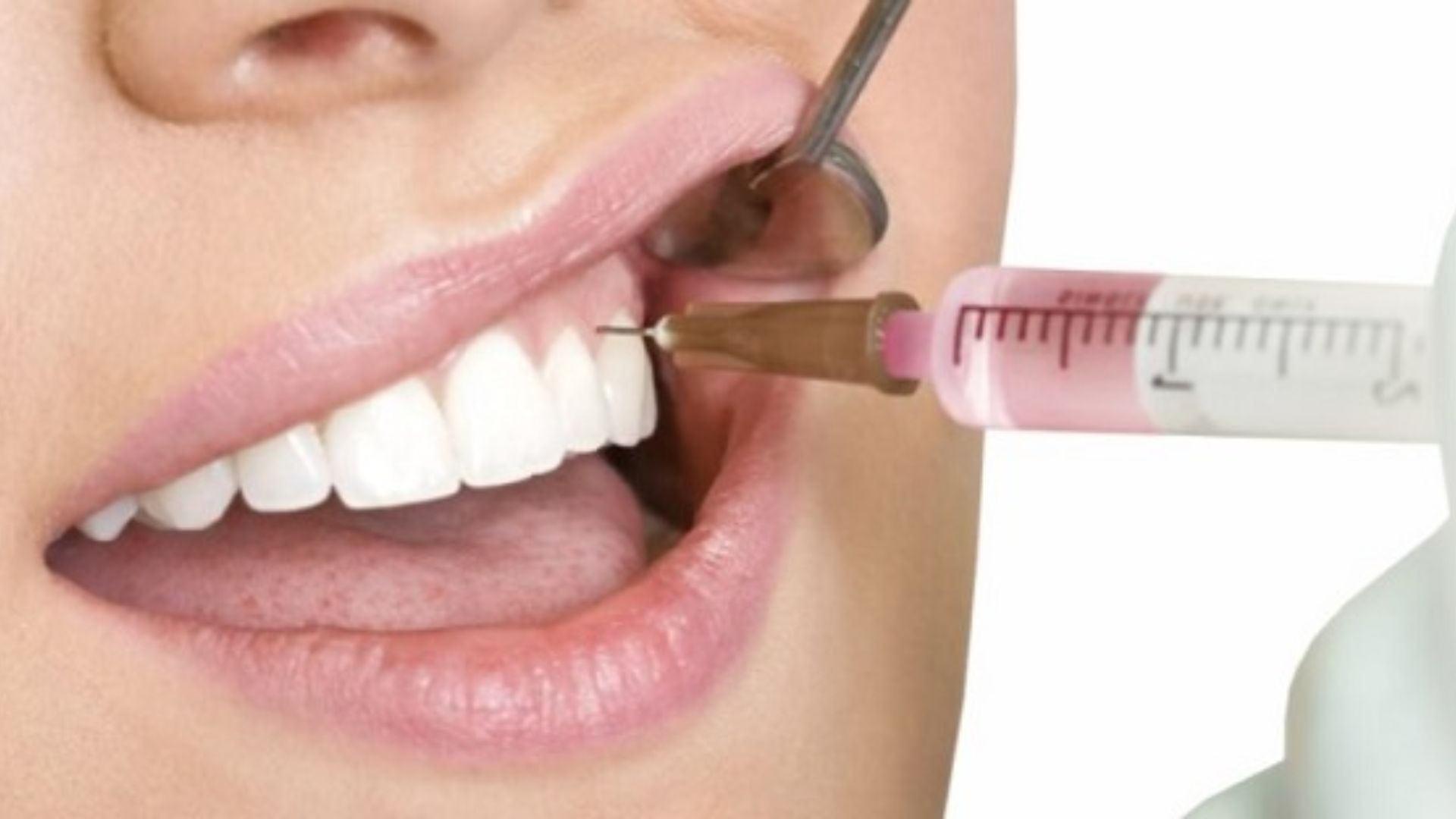 Cười Hở Lợi Nguyên Nhân Và Phương Pháp Điều Trị