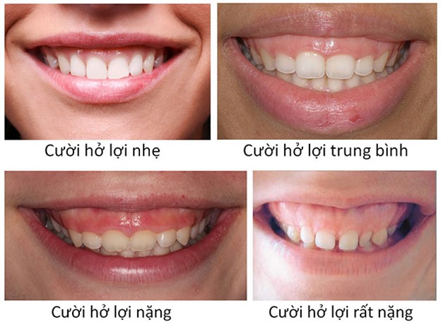 Cười Hở Lợi Nguyên Nhân Và Phương Pháp Điều Trị