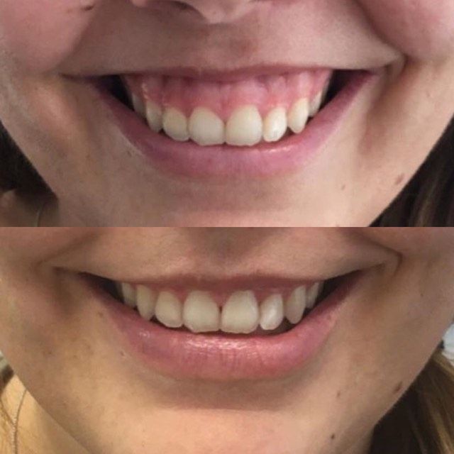 Cười Hở Lợi Nguyên Nhân Và Phương Pháp Điều Trị