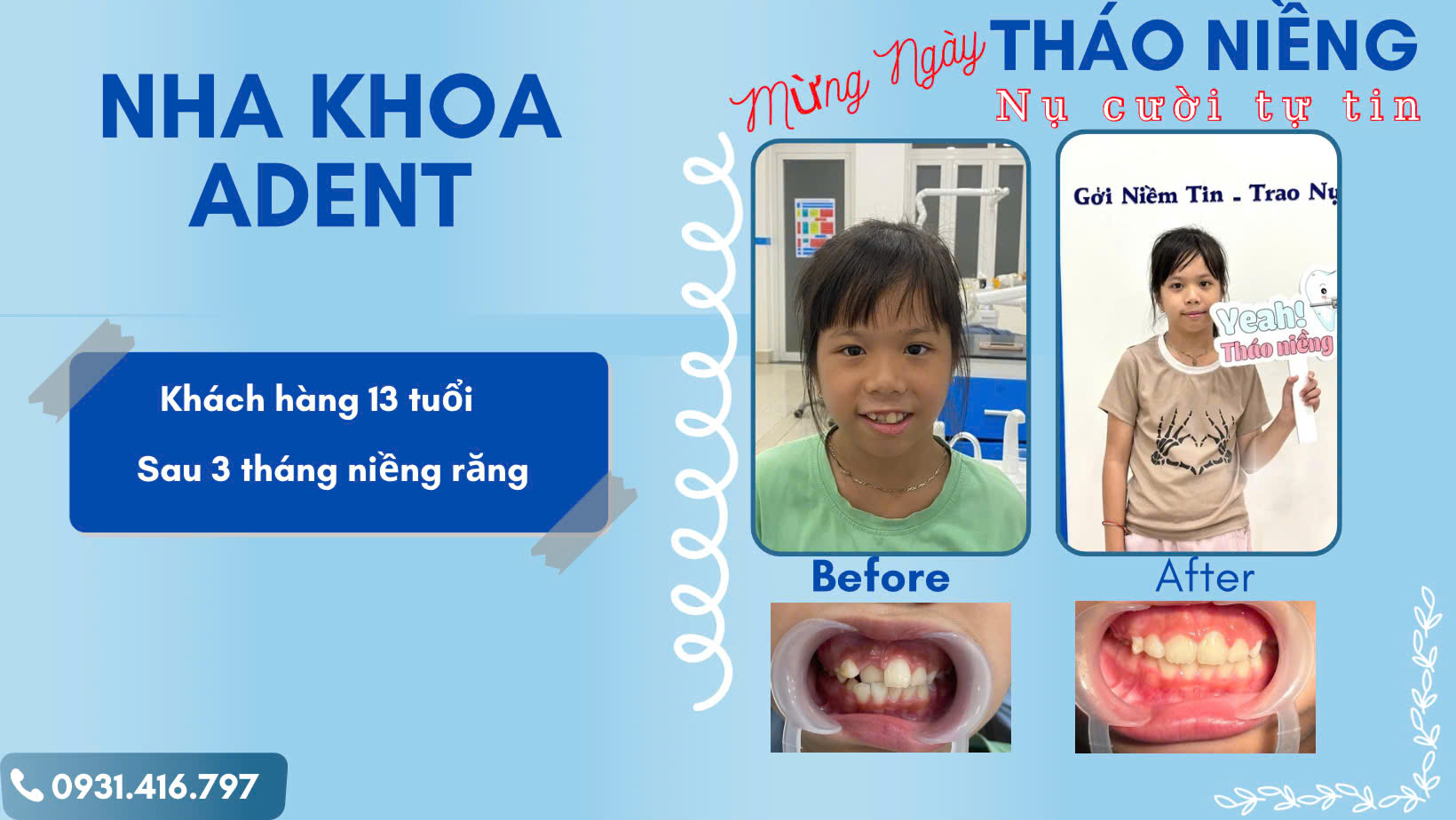 Nha Khoa Trẻ Em Tại Nha Khoa Adent Bình Tân