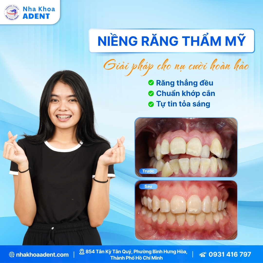 Niềng Răng Trả Góp Bình Tân – Chỉ Từ 500ktháng, 0% Lãi Suất!
