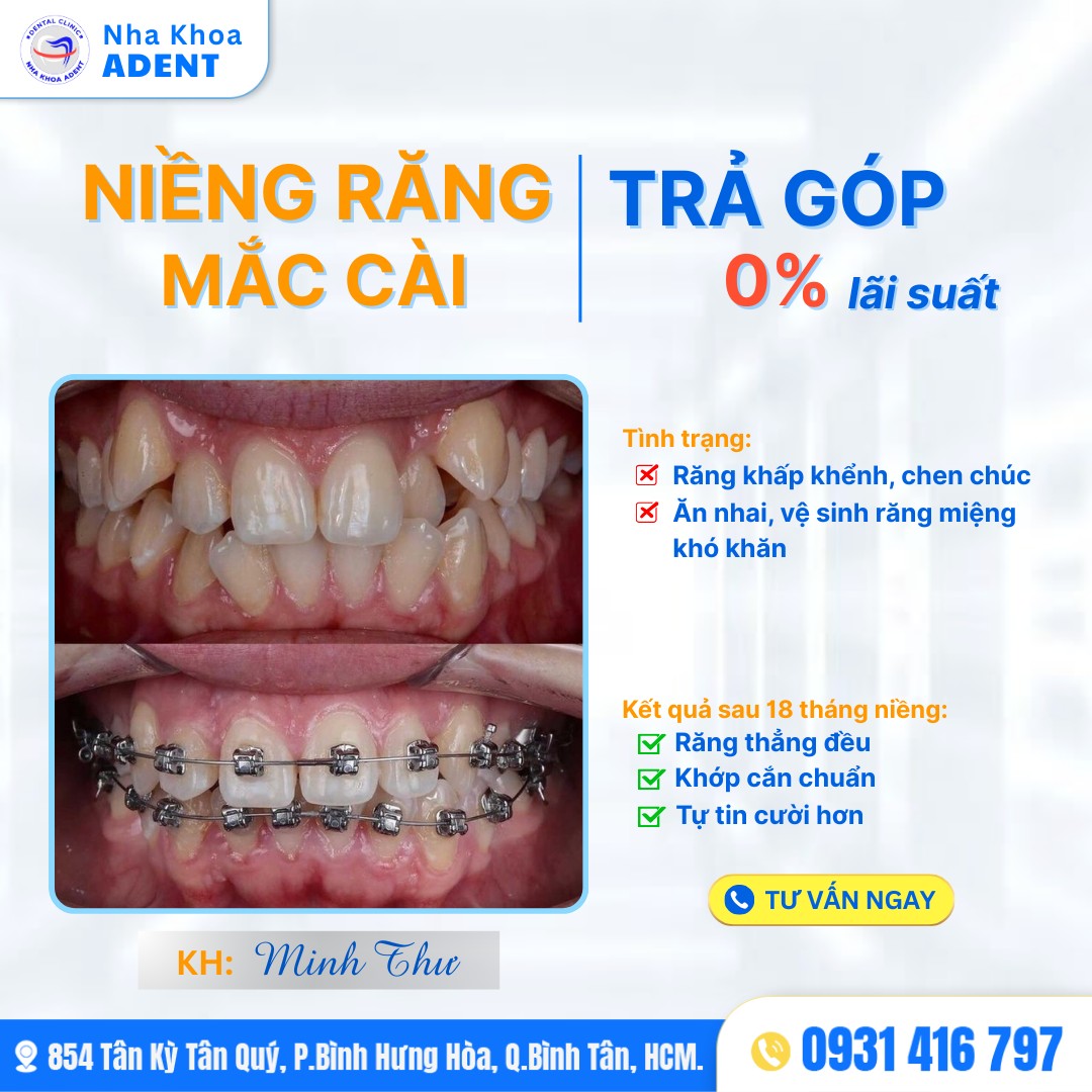Niềng Răng Trả Góp Bình Tân – Chỉ Từ 500ktháng, 0% Lãi Suất!