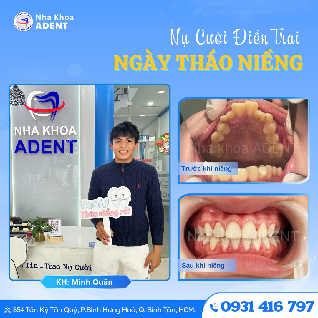 Niềng Răng Trả Góp Bình Tân – Chỉ Từ 500ktháng, 0% Lãi Suất!