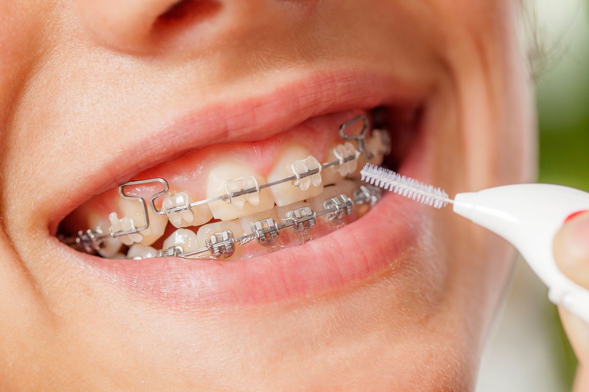 Niềng Răng Trẻ Em