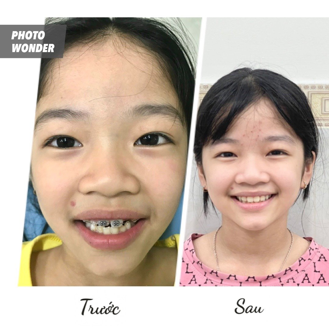 Niềng Răng Trẻ Em