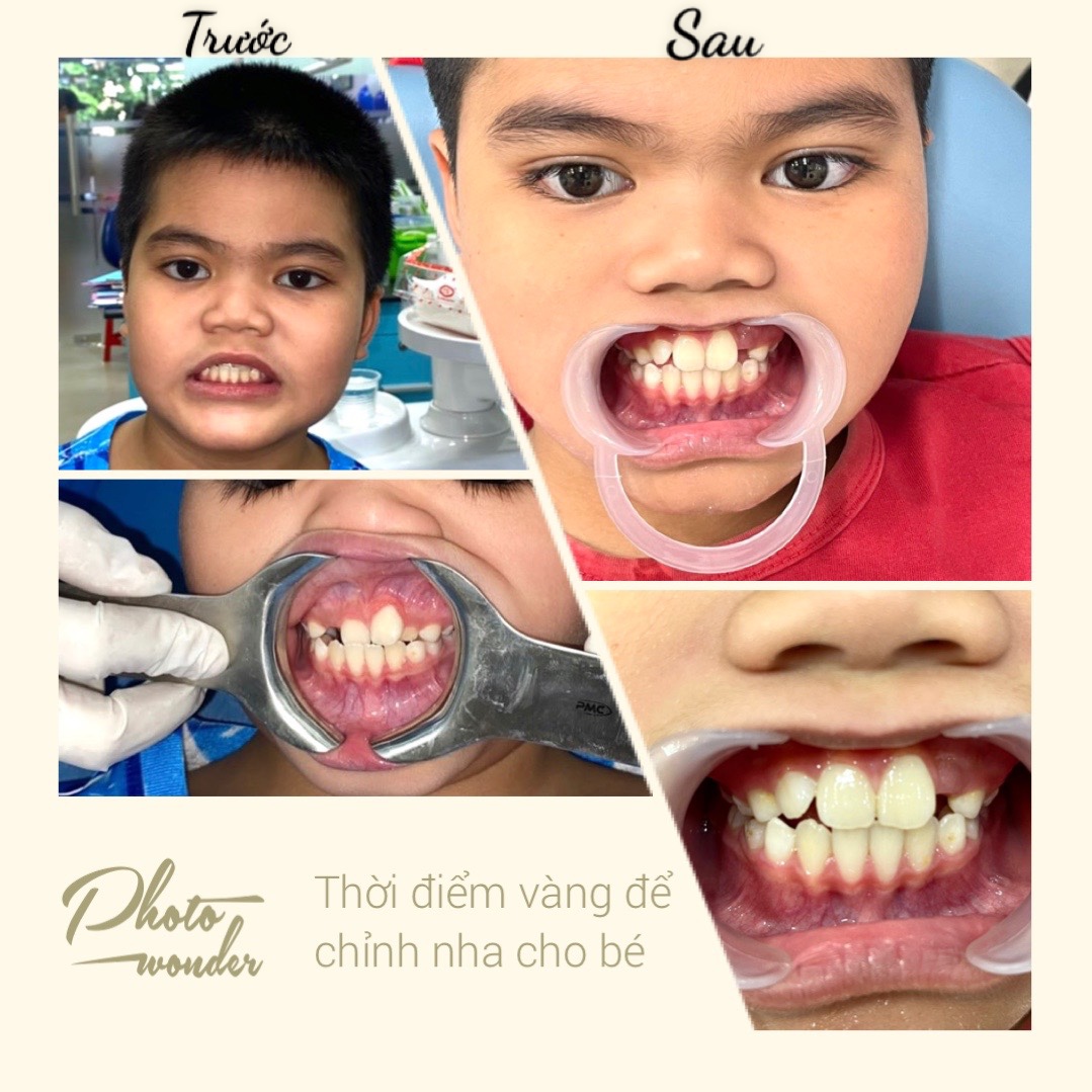 Niềng Răng Trẻ Em