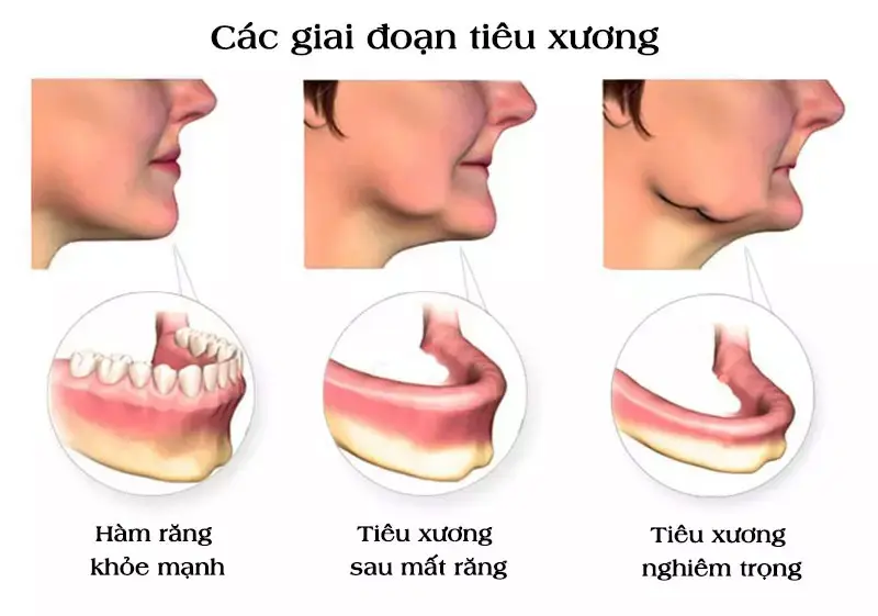 Tiêu Xương Hàm Là Gì Nguyên Nhân Và Cách Phòng Ngừa Hiệu Quả (1)
