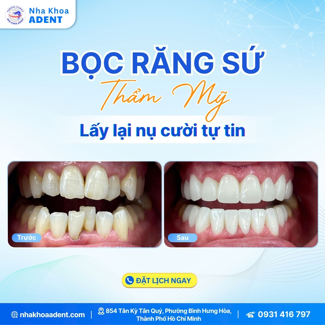 Bảng Giá Bọc Răng Sứ Mới Nhất 2025