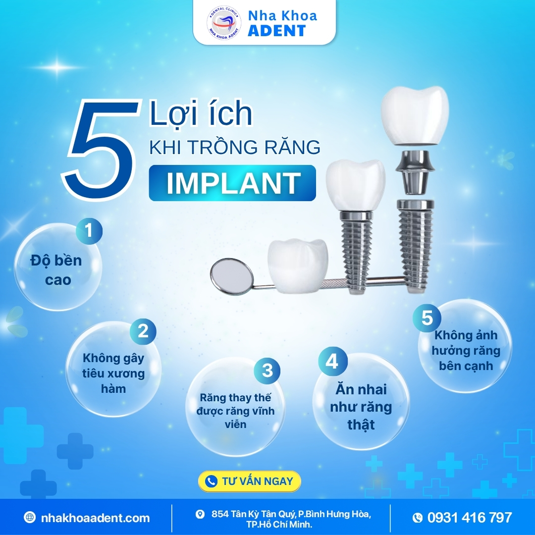Trồng Răng Implant Uy Tín Bình Tân Tại Nha Khoa Adent