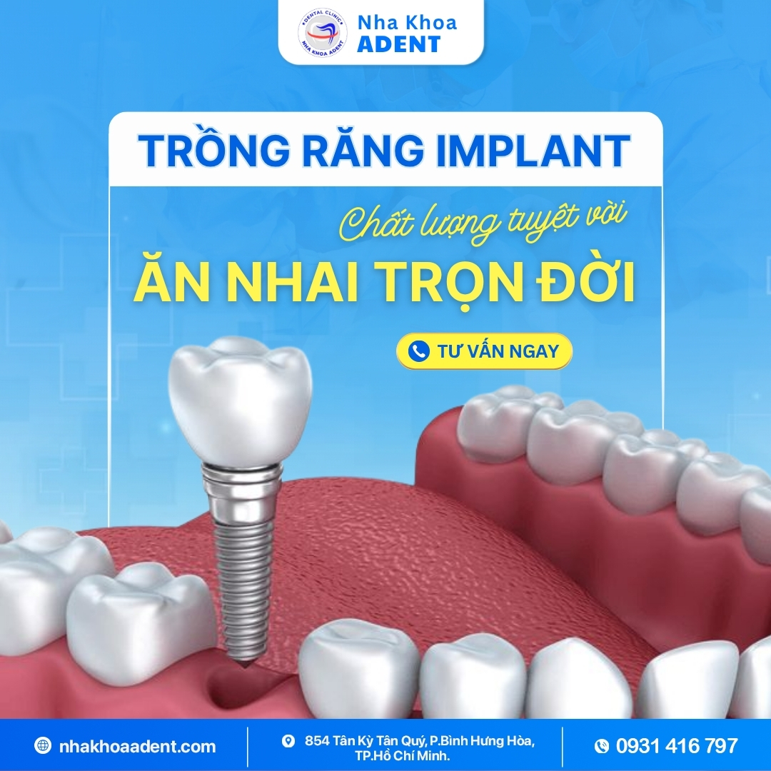 Trồng Răng Implant Uy Tín Bình Tân Tại Nha Khoa Adent