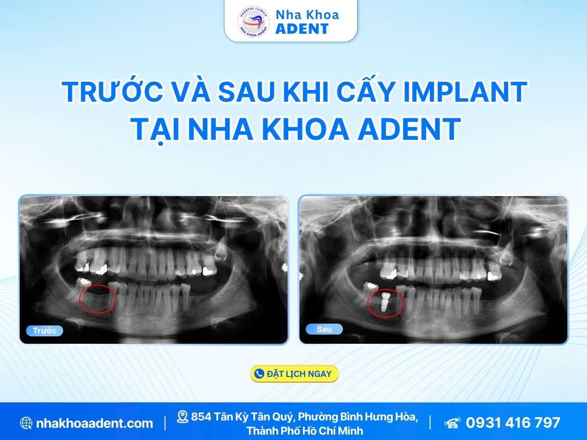 Trồng Răng Implant Uy Tín Bình Tân Tại Nha Khoa Adent