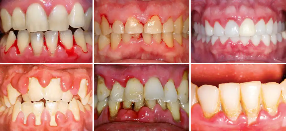 7 Dấu Hiệu Tiêu Xương Răng (1)