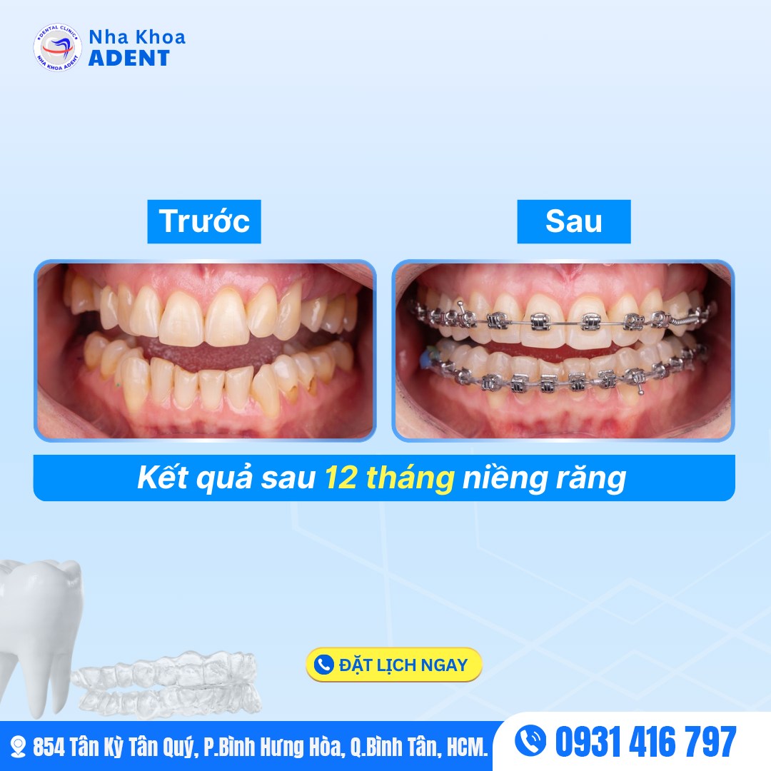 Hướng Dẫn Chăm Sóc Sau Niềng Răng Đúng Cách