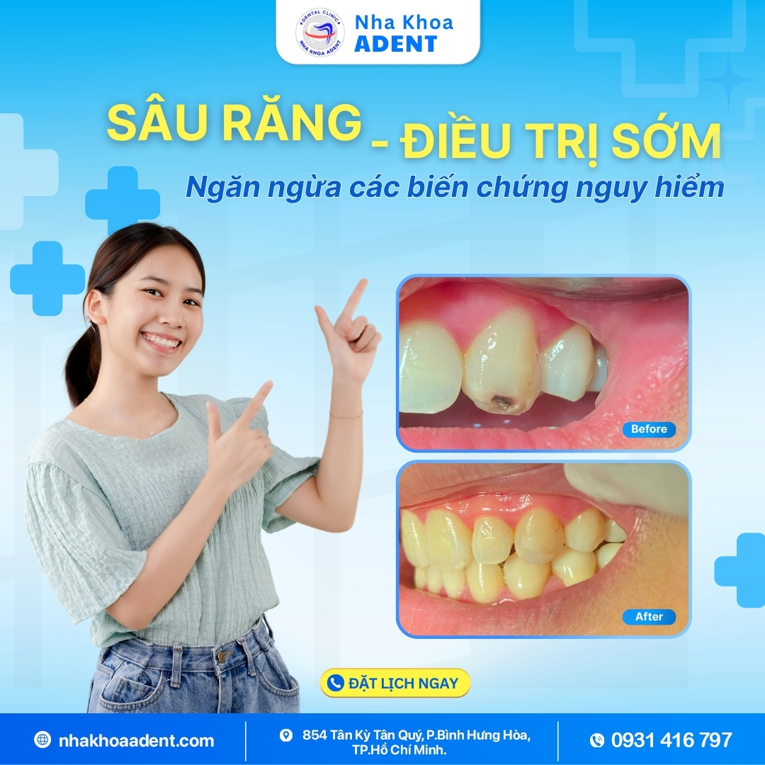 Làm Sao Để Ngừa Sâu Răng Hiệu Quả