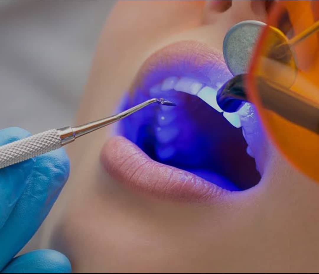 Công Nghệ Tẩy Trắng Răng Laser Whitening