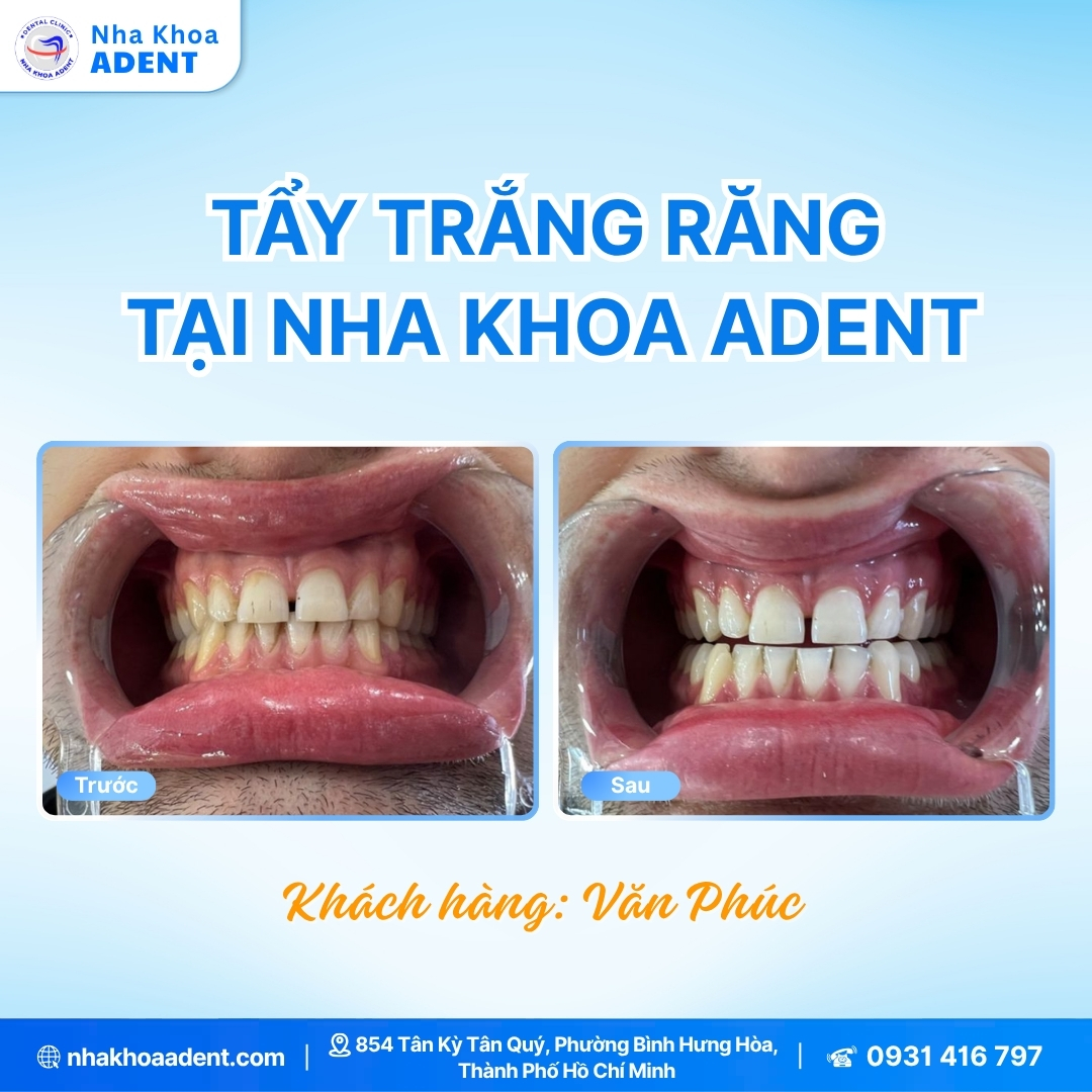 Công Nghệ Tẩy Trắng Răng Laser Whitening